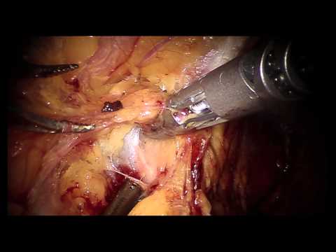 Prostate Pelvic Lymph Node Dissection 
