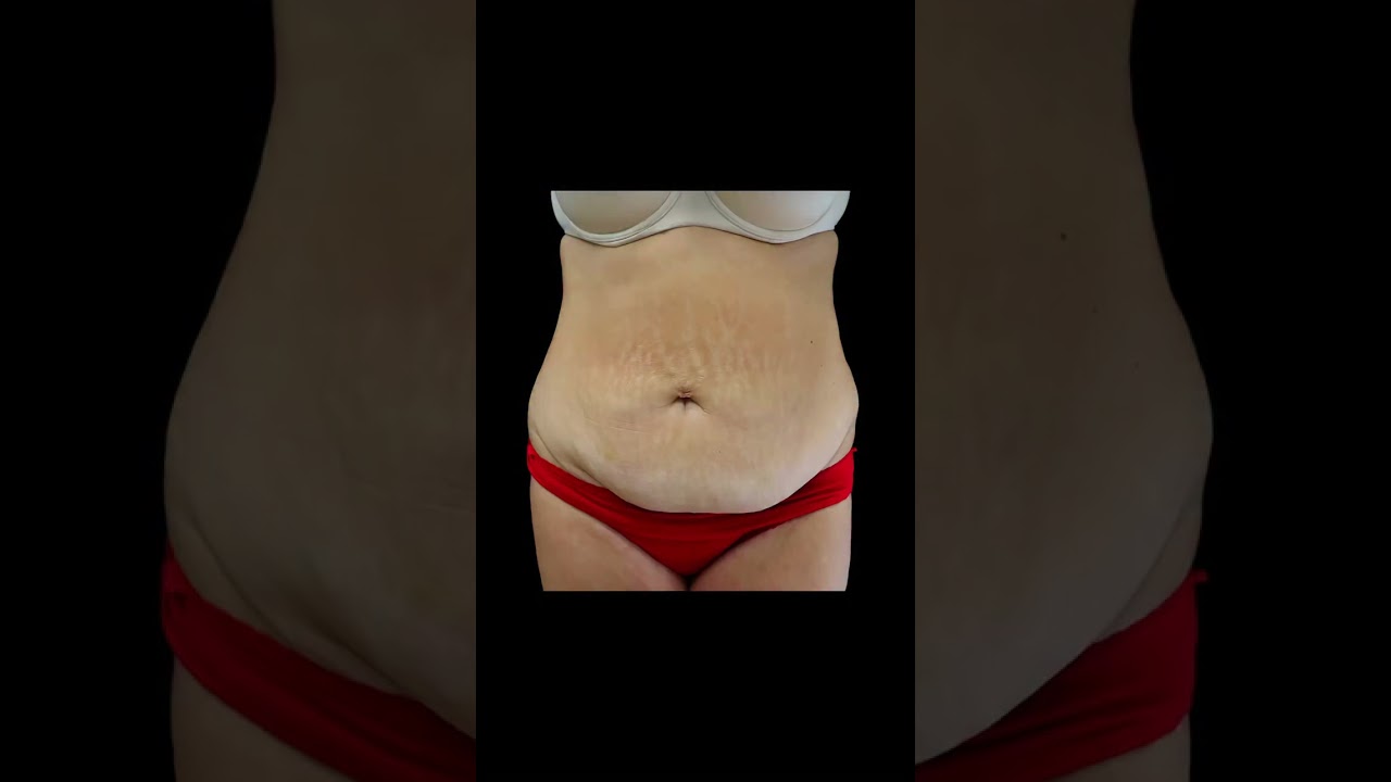 חודש בלבד לאחר ניתוח מתיחת בטן