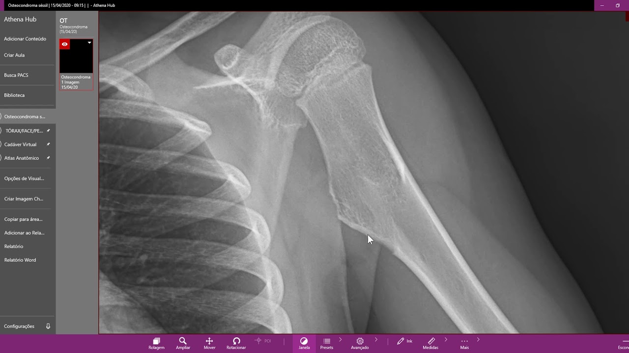 Osteocondroma séssil