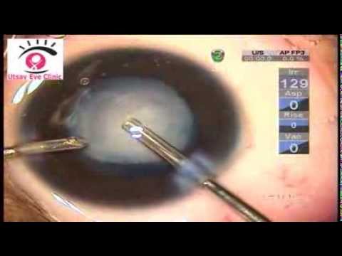 Pediatric Cataract Surgery in Navi Mumbai, India