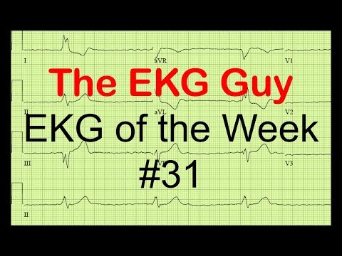 EKG/ECG of the Week #31 | The EKG Guy - www.ekg.md