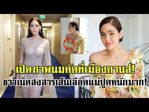 ขยายเต้านม 280 มล. วิธีการเสริมเต้านม