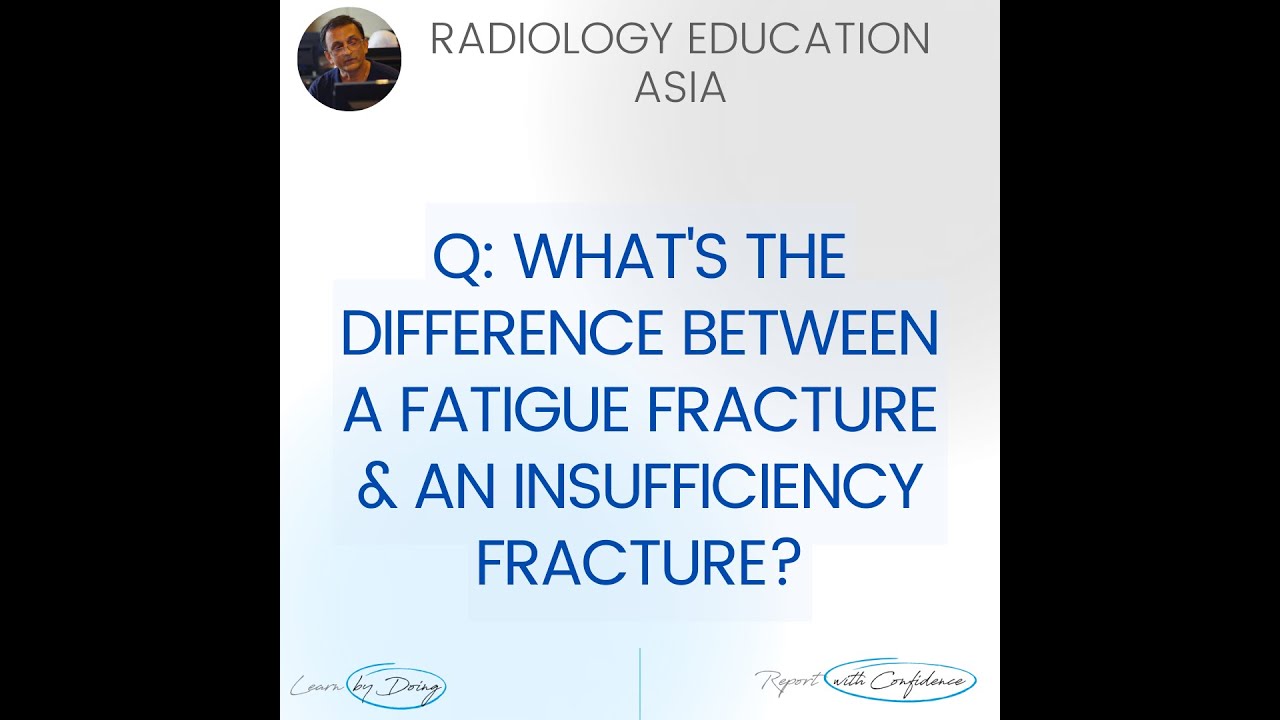 What is the difference between fatigue and fracture? Tipseri