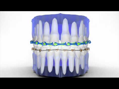 MyDental | FastBraces | Double Powerchain