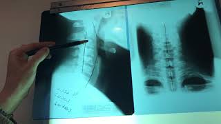 Dolor de cuello después de un accidente