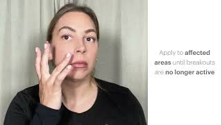 Quick Guide to Acne Spot Treatment by Glo Skin Beauty