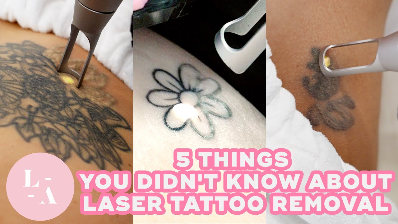 5 Things You Didn't Know About Laser Tattoo Removal