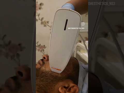 Venus Viva for skin Resurfacing | Beyond Aesthetics