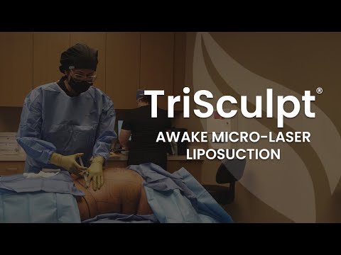 Awake Micro-Laser Liposuction Procedure | Live TriSculpt Fat Removal Procedure Explained w/ Dr.Vega
