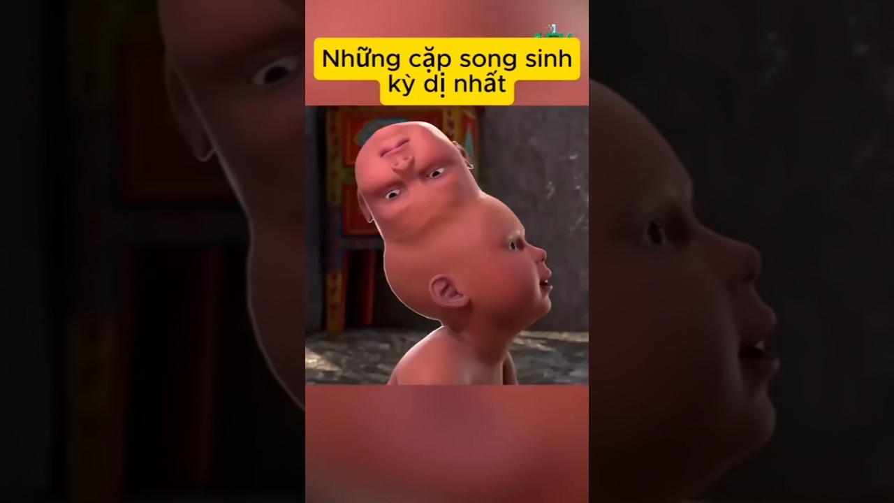 Những cặp song sinh kỳ dị nhất