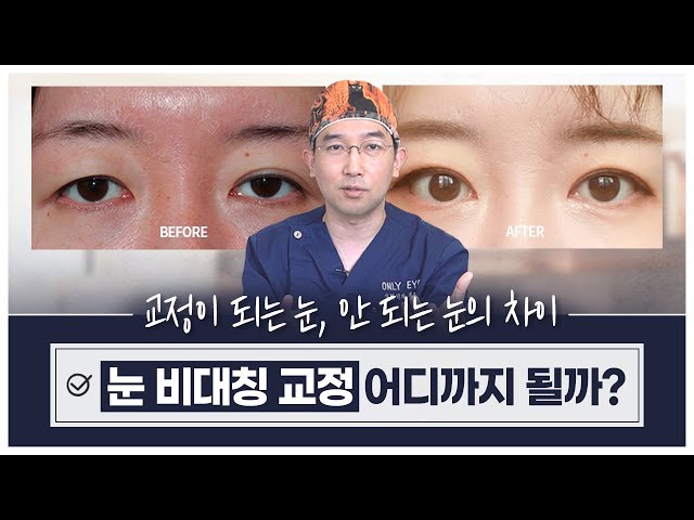 온리아이성형외과_절개쌍꺼풀_비대칭 교정 (짝눈교정) 온리아이성형외과_절개쌍꺼풀_비대칭 교정 (짝눈교정)