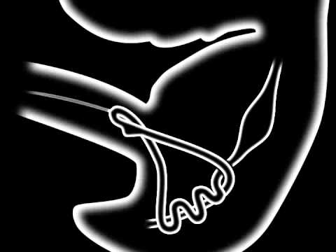 Rotation of the midgut