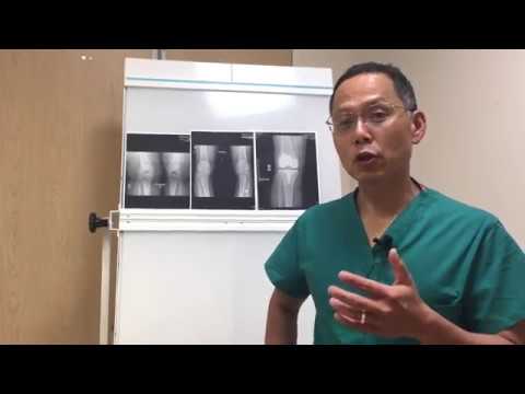 How To Read An X-ray Of Your Knee