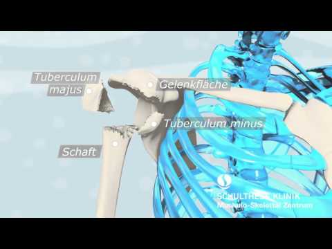 Ob oder ob nicht steigt der Blutdruck mit zervikaler Osteochondrose Heilung von grünen Pinienzapfen für Gelenke