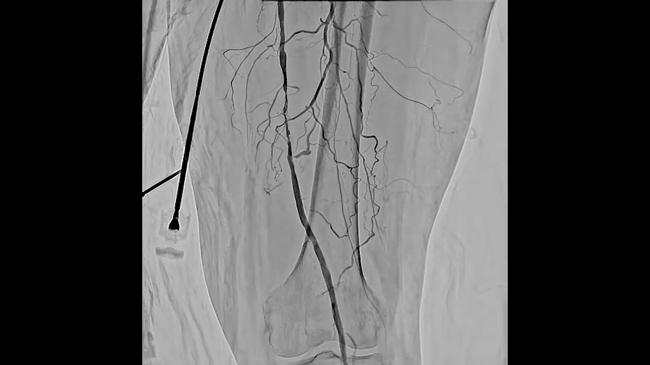 EVT Video: Bolus chase with Score RSM
