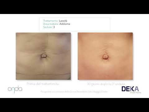 Onda Coolwaves - Charme Medic Beauty Clinic - Risultati Clinici