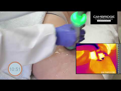 ONDA Coolwaves™ Cellulite Treatment