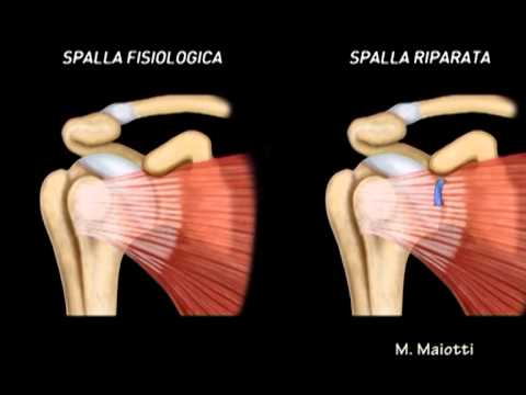 Come sbarazzarsi del dolore alla schiena tra le scapole Frattura dei sintomi spalla e trattamento