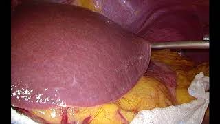 Liver Retraction with Suture Grasper Device