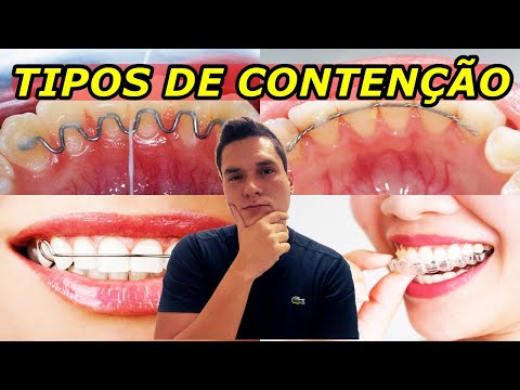 TIPOS DE CONTENÇÂO ORTODÔNTICA | VANTAGENS E DESVANTAGENS | QUAL A MELHOR?