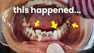 She got braces put on by a fake dentist...in a garage...