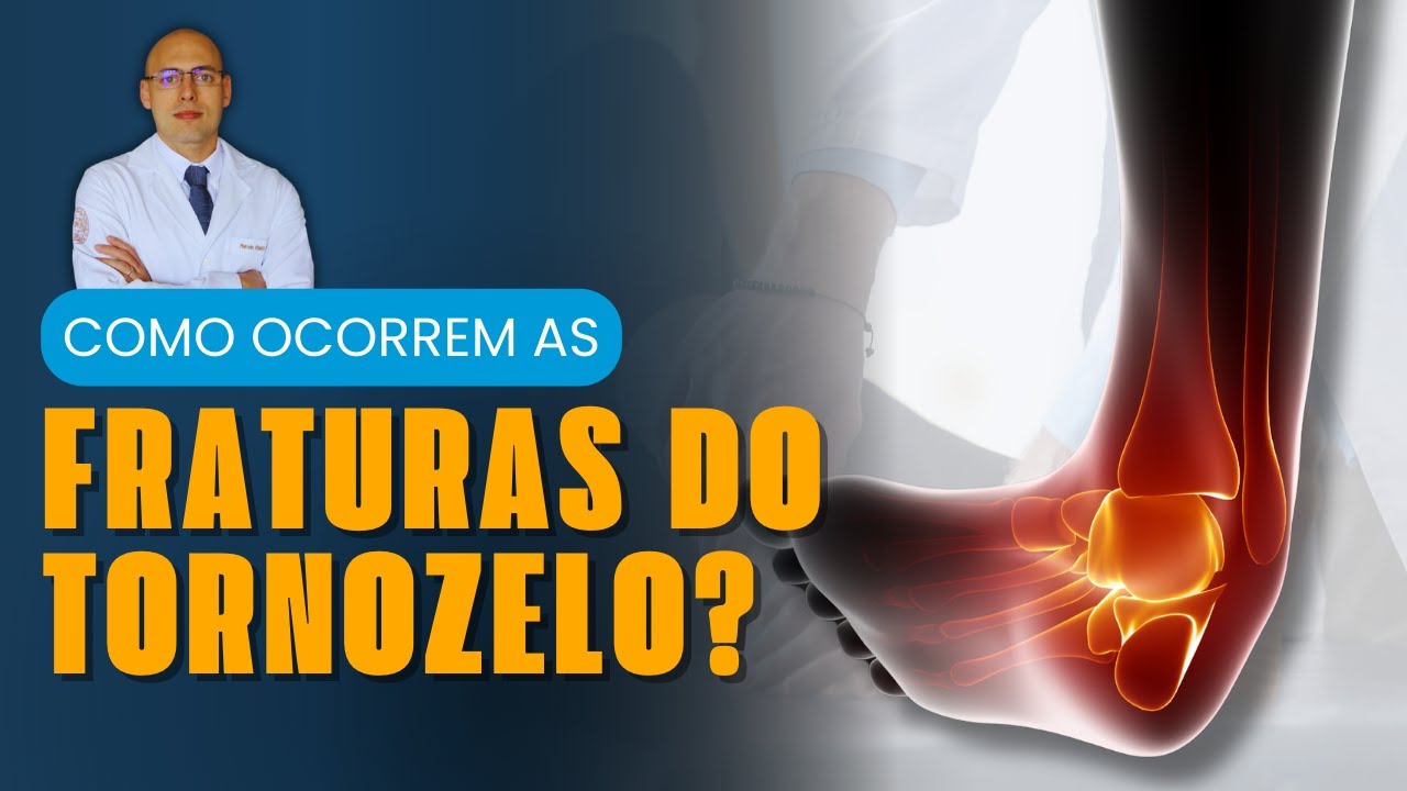 TORNOZELO QUEBRADO? COMO AS FRATURAS ACONTECEM E O QUE FAZER PARA EVITAR