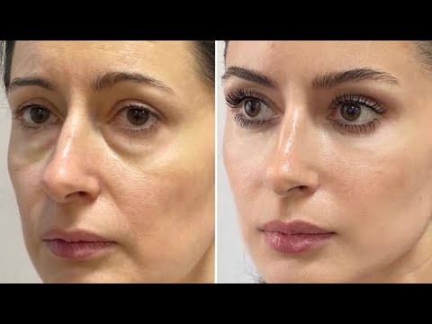 COMPLETE FACE LIFT PROCEDURE ⚠︎ (extreme)