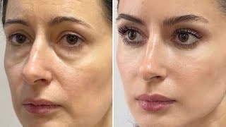 COMPLETE FACE LIFT PROCEDURE ⚠︎ (extreme)