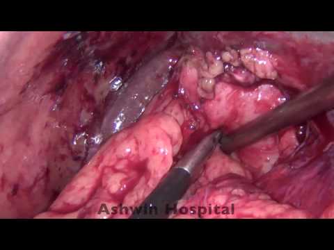 Laparoscopic Cholecystectomy with Intra-operative Cholangiogram Video