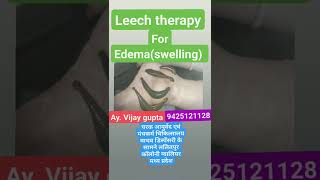 leech therapy for edema