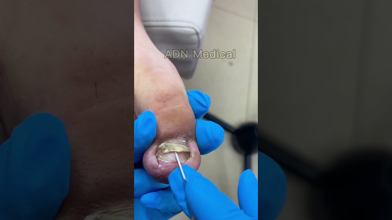 Deep Toenail Cleaning for Better Foot Comfort  #fypシ #nailcare #cleannails #footcare #pedicure