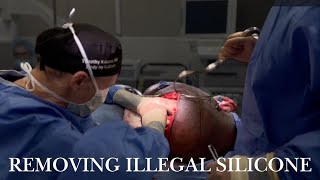 Surgical Removal of Illegal Silicone Injections of the Buttocks (Posterior Buttock Lift)