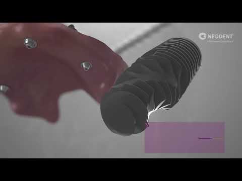 Neodent® NeoArch® Immediate Fixed Full Arch Solution