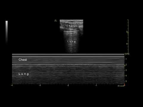 PoCUS eFAST - Pleural View