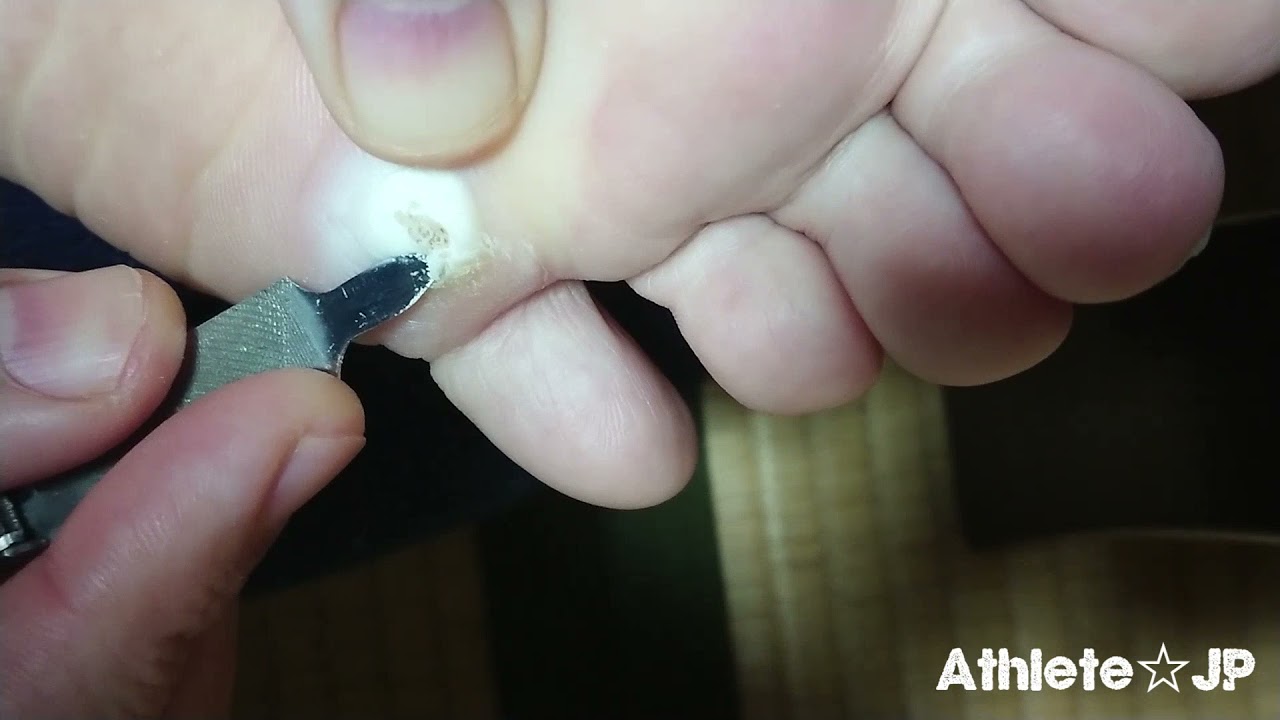 【閲覧注意】魚の目・芯除去！? ウオノメコロリ鶏眼