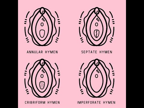 imperforate hymen; hymen thin membrane at the vaginal opening fails to develop a normal opening