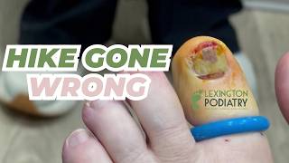 Blood Build Up | Nail Removal
