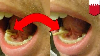 Man squeezes salivary stone out from tongue - TomoNews