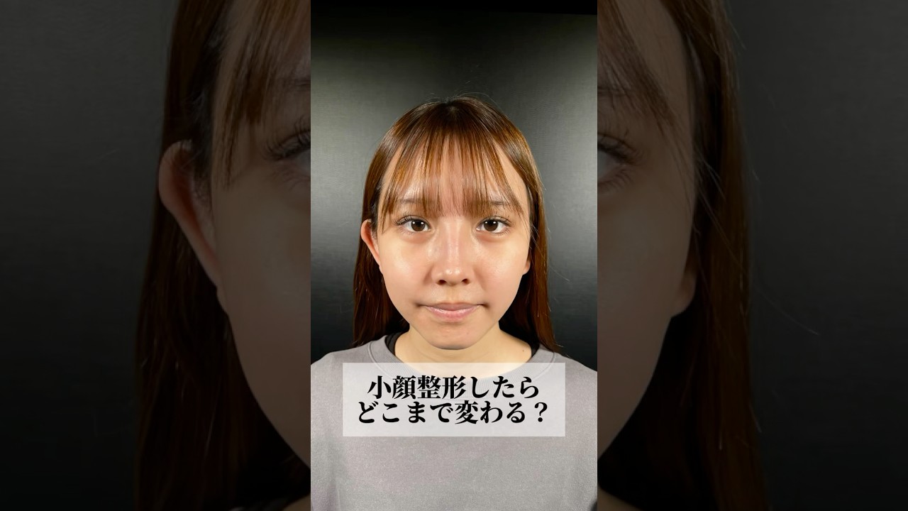 【小顔整形したらどこまで変わる？】#shorts