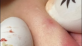 Relaxing Acne Cleansing with LinhMyDang  #616