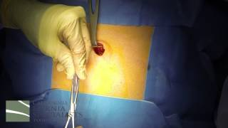 Umbilical Hernia Repair at California Hernia Speci