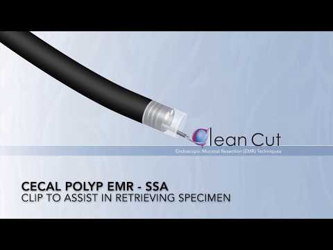 Colonoscopy: Cecal EMR - SSA - Clip Retrieval of a Polyp