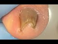 Extremely satisfying ingrown toenail treatment