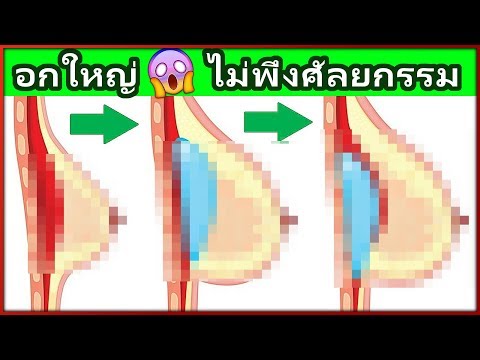 Daria Pynzar เพิ่มขึ้นซิลิโคนเต้านม บินเพื่อขยายหน้าอก