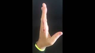 Retraining normal pattern of motion after a finger fracture