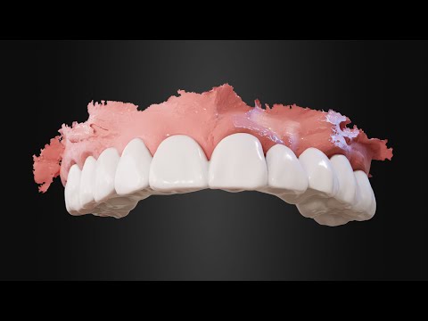 Profilo Full-Arch Guided Surgery: an Inserta livestream.