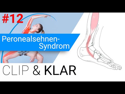 Peronealsehnen-Syndrom erklärt - Sehnenschädigung am Fuss-Aussenknöchel