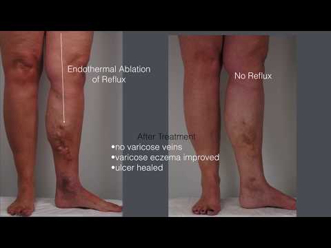 Neurodermatitis di passaggio posteriore di una fotografia Incrinature su psoriasi di trattamento di mani