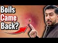 Boils Keep Coming Back What To Do Stop Recurring Boils NOW
