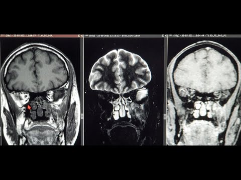 MRI in MucorMycosis | Necrosed Sphenopalatine & Maxillary Artery | Necrosed Pterygopalatine Fossa
